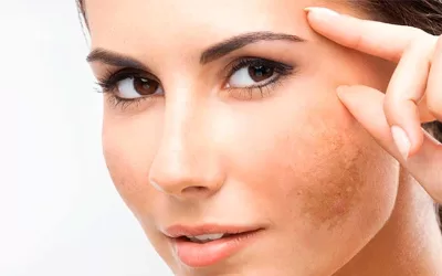 Melasma ¿Qué es y como cuidarlo?