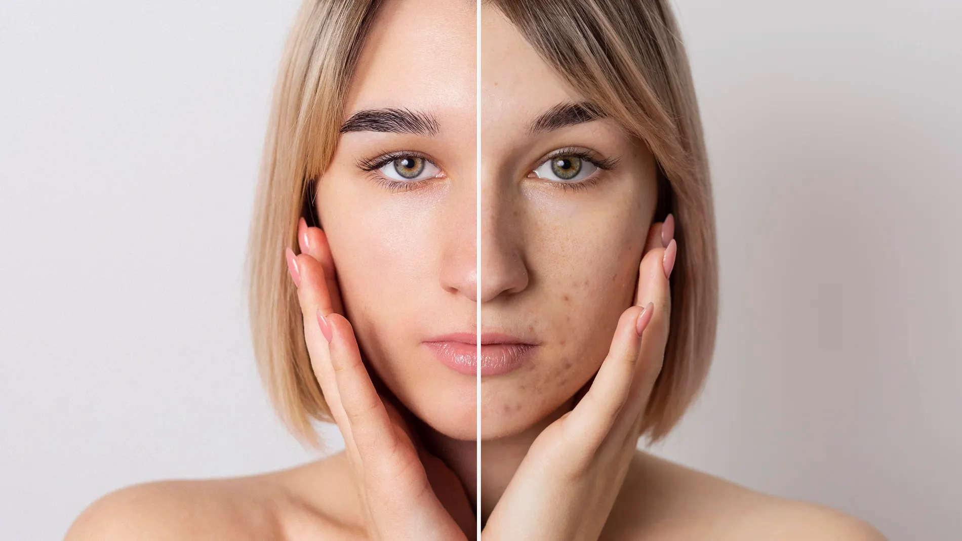 consejos de cosmética ecologica piel con acné